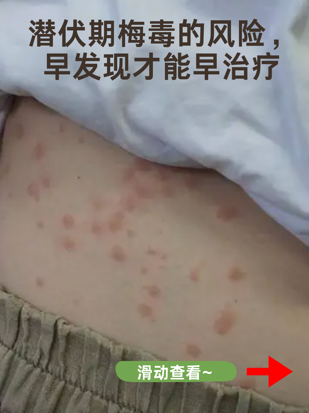 “德尔塔毒株或导致更严重疾病” 德尔塔毒株的临床症状？-第3张图片